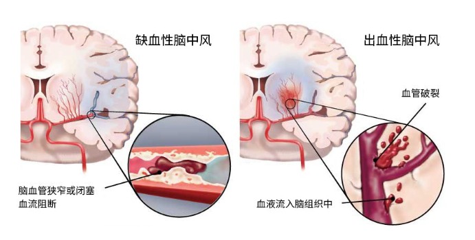 得了腦中風(fēng)保險公司怎么賠